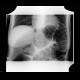 Sigmoid volvulus, ileus: X-ray - Plain radiograph